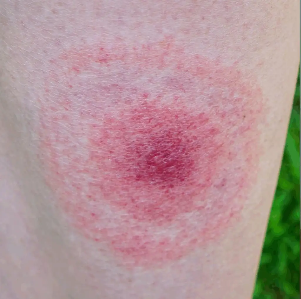 what does a spider bite look like