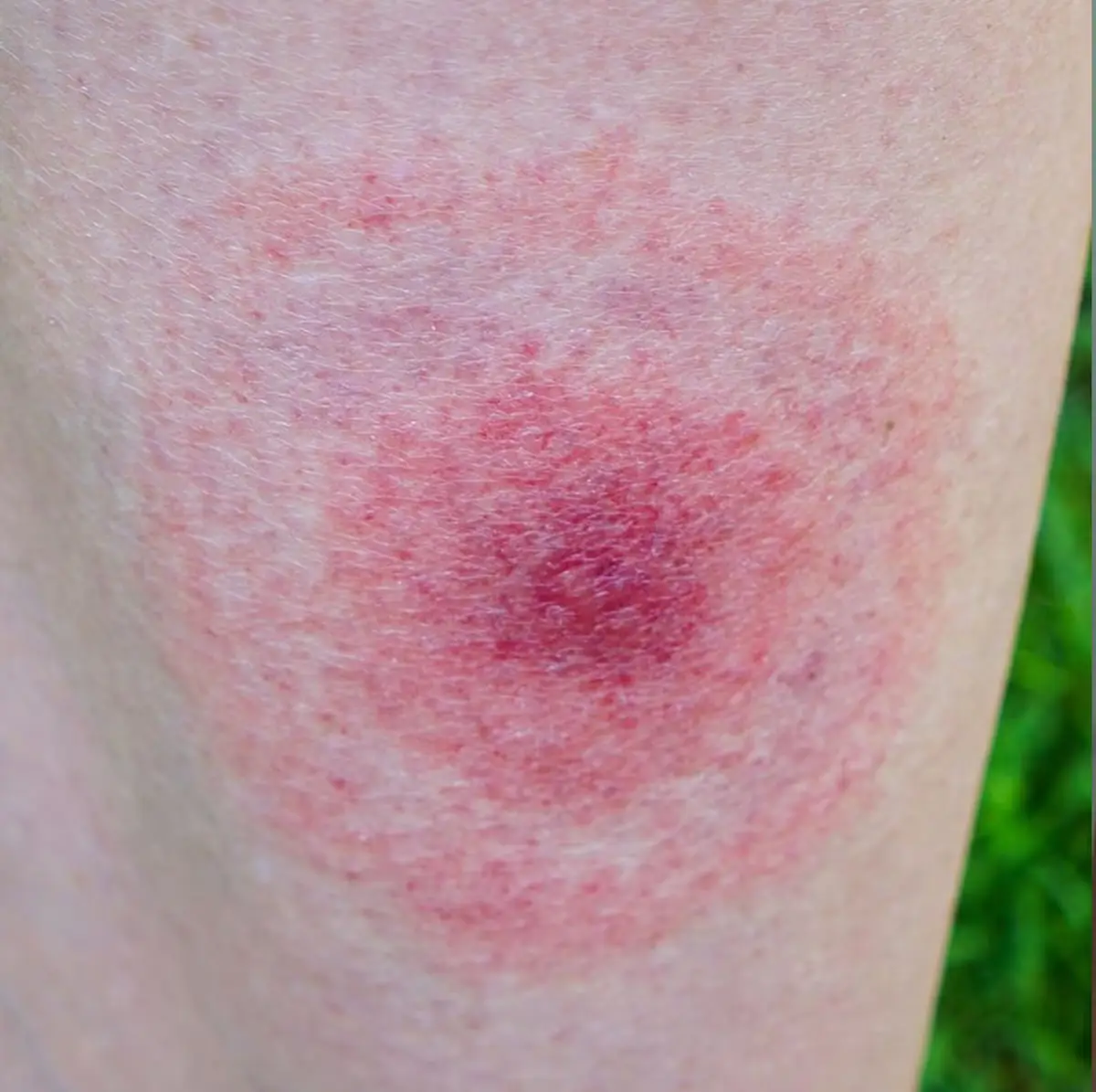 Cal King Pest Control   Cal King Pest Control   what does a spider bite look like