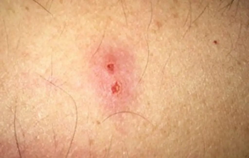 what does a spider bite look like