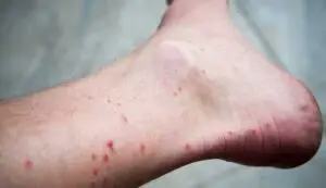 flea bites - Cal King Pest Control Cal king pest control - what do flea bites look like, flea bites
